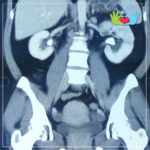 Litotripsia Endoscopica Neumática