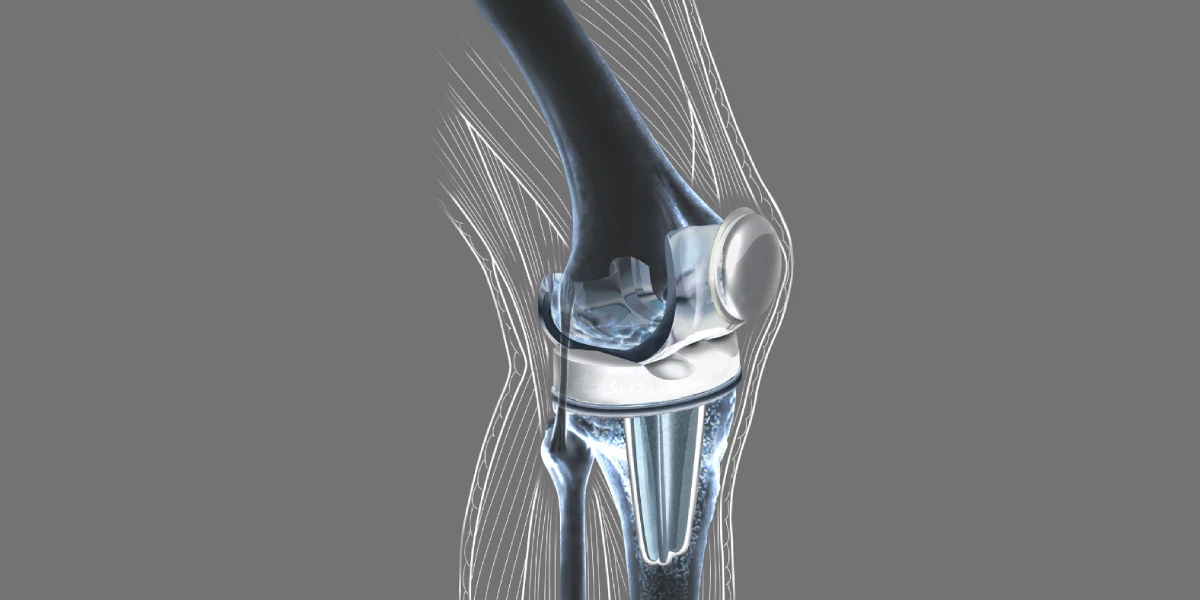 Todo sobre la prótesis de rodilla