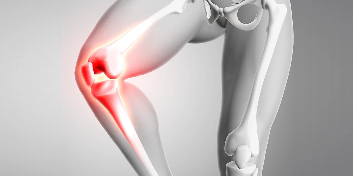 ¿Qué tan recomendable es la prótesis de rodilla?